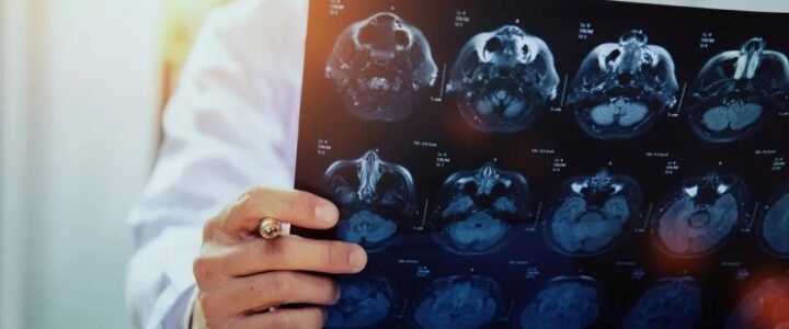 Casos de AVC aumentam no país e reforçam alerta sobre prevenção e monitoramento da saúde